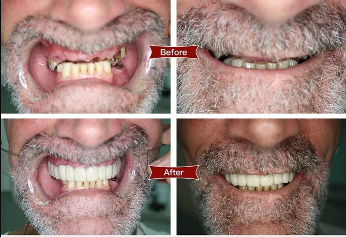 The latest sixth generation of adjustable snap-on dentures (2023 Edition)【🎌From Japan🎌】