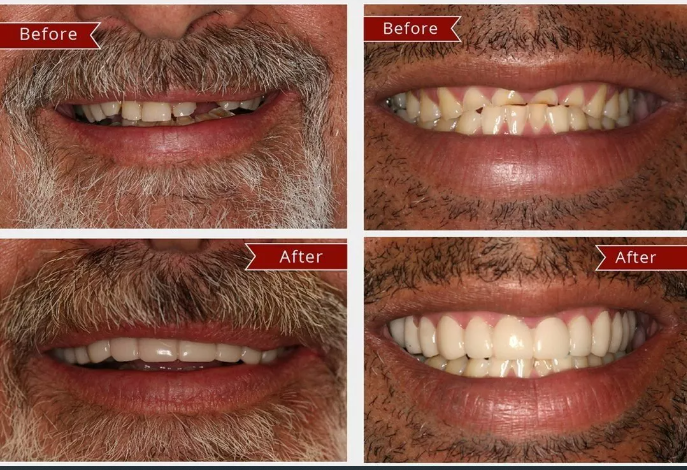 The latest sixth generation of adjustable snap-on dentures (2023 Edition)【🎌From Japan🎌】